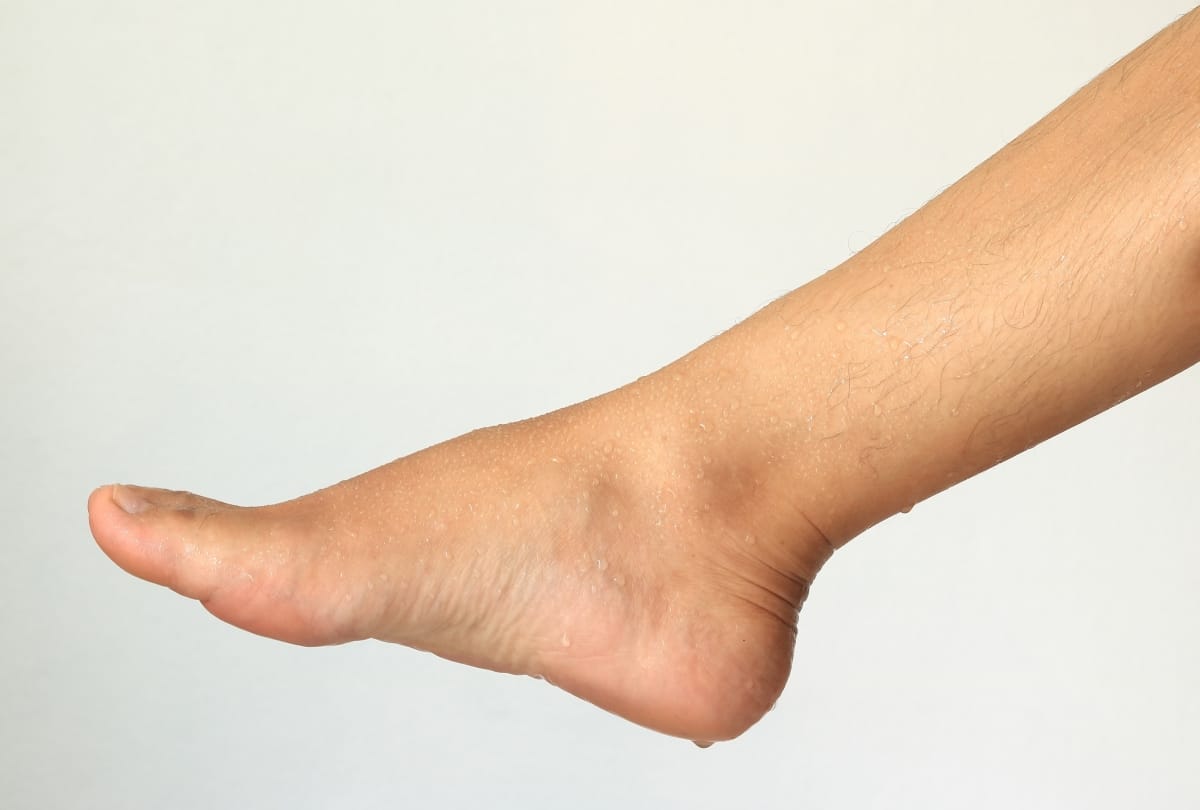 remedies for sweat problem in foot