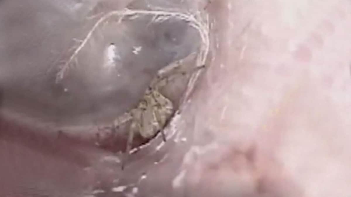Video: itchy IN Man ear doctors were shocked spider weaving webs inside