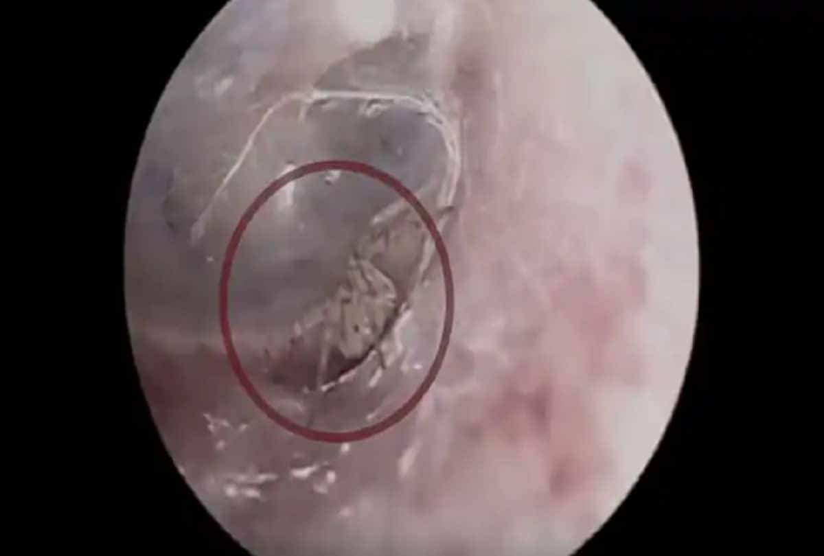 Video: itchy IN Man ear doctors were shocked spider weaving webs inside