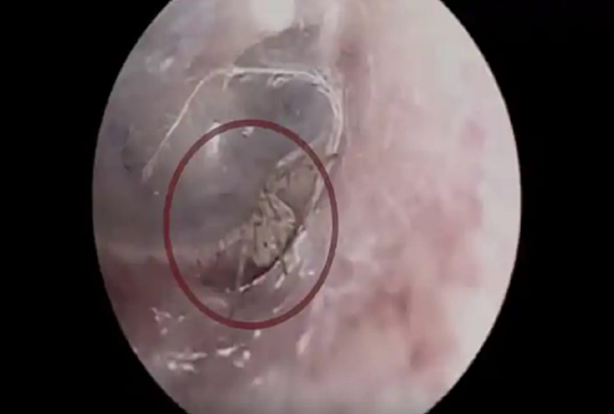 Video: itchy IN Man ear doctors were shocked spider weaving webs inside