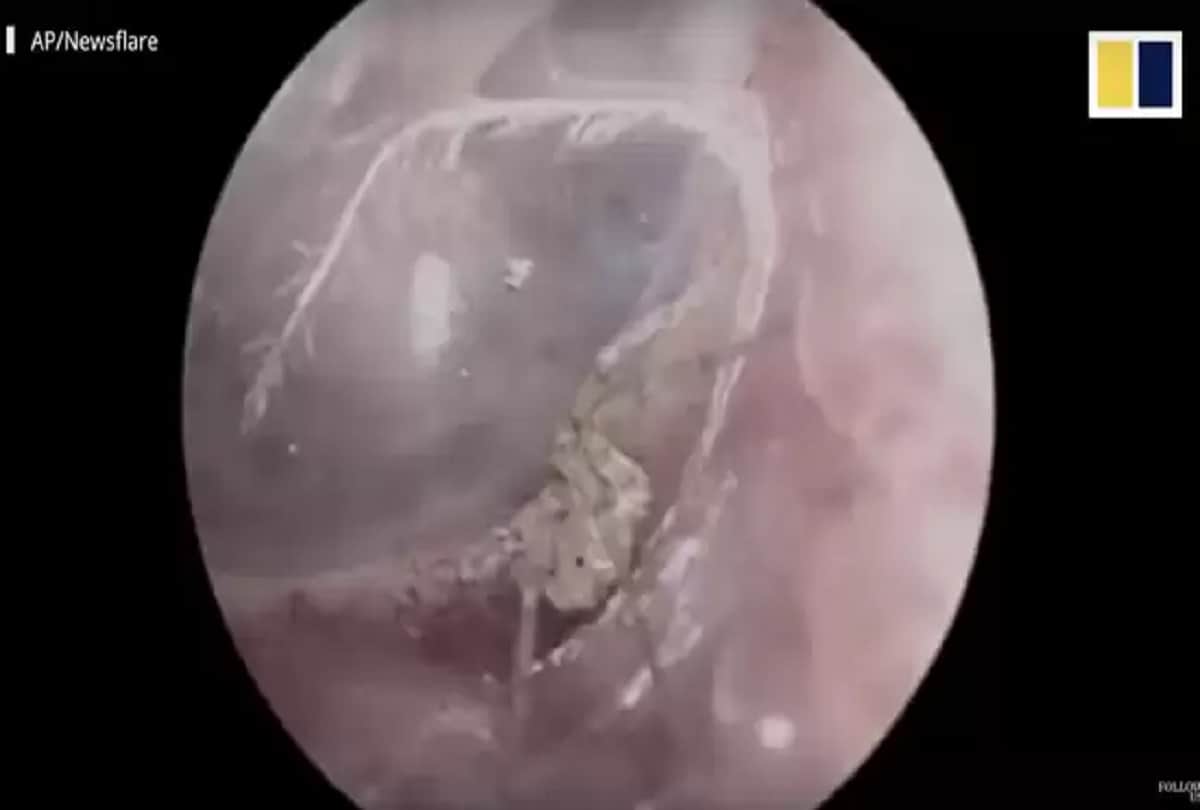 Video: itchy IN Man ear doctors were shocked spider weaving webs inside