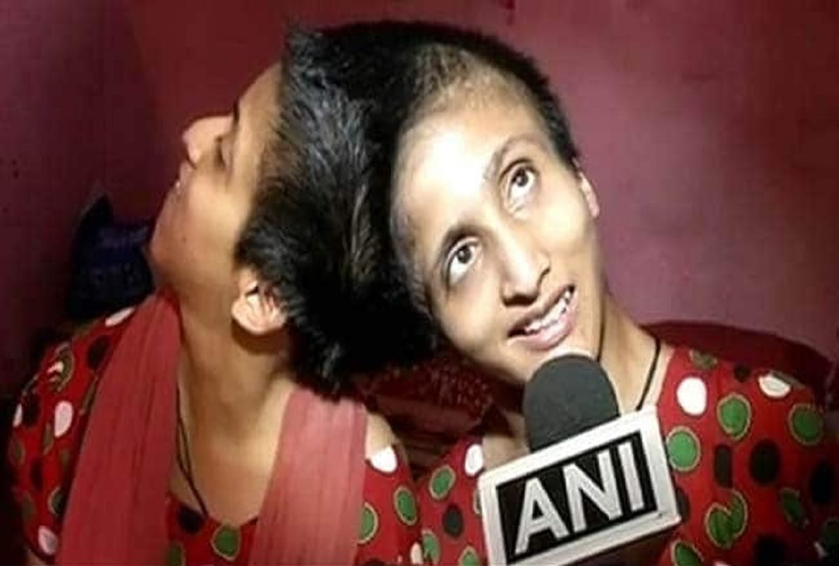 Bihar: Right to vote separately for conjoined twins