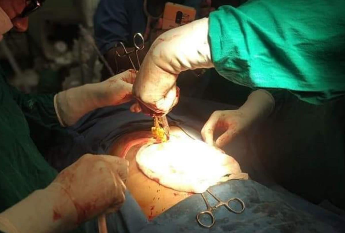Doctors found toothbrush iron rod spoon and Screwdriver in patient stomach