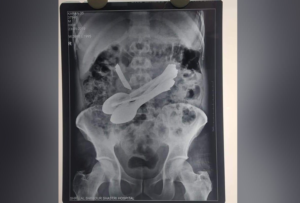 Doctors found toothbrush iron rod spoon and Screwdriver in patient stomach