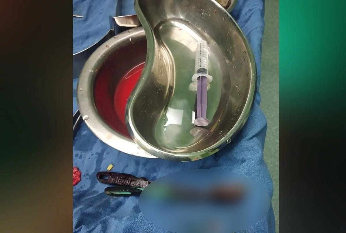 Doctors found toothbrush iron rod spoon and Screwdriver in patient stomach