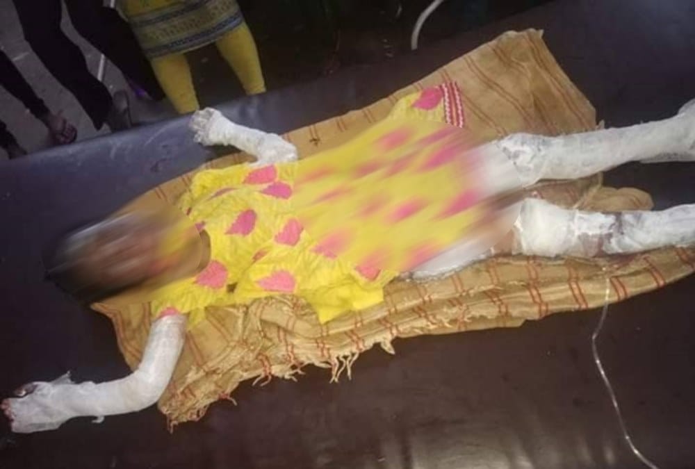 Girl scorched in wildfire at pithoragarh forest
