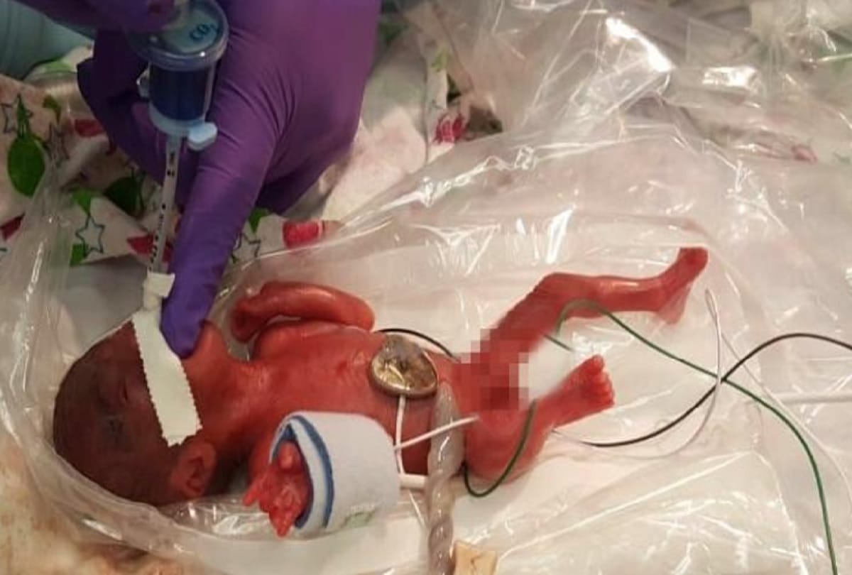 World Smallest Baby Girl Released From Hospital In US