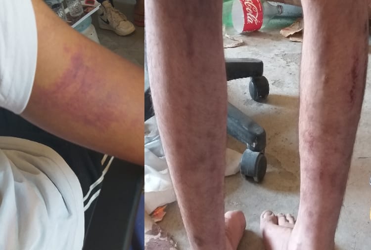 Third Degree Torture on Patients at Nasha Mukti Kendra