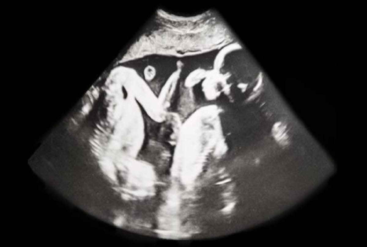 preterm birth increase risk, know its cause and effect on health in hindi