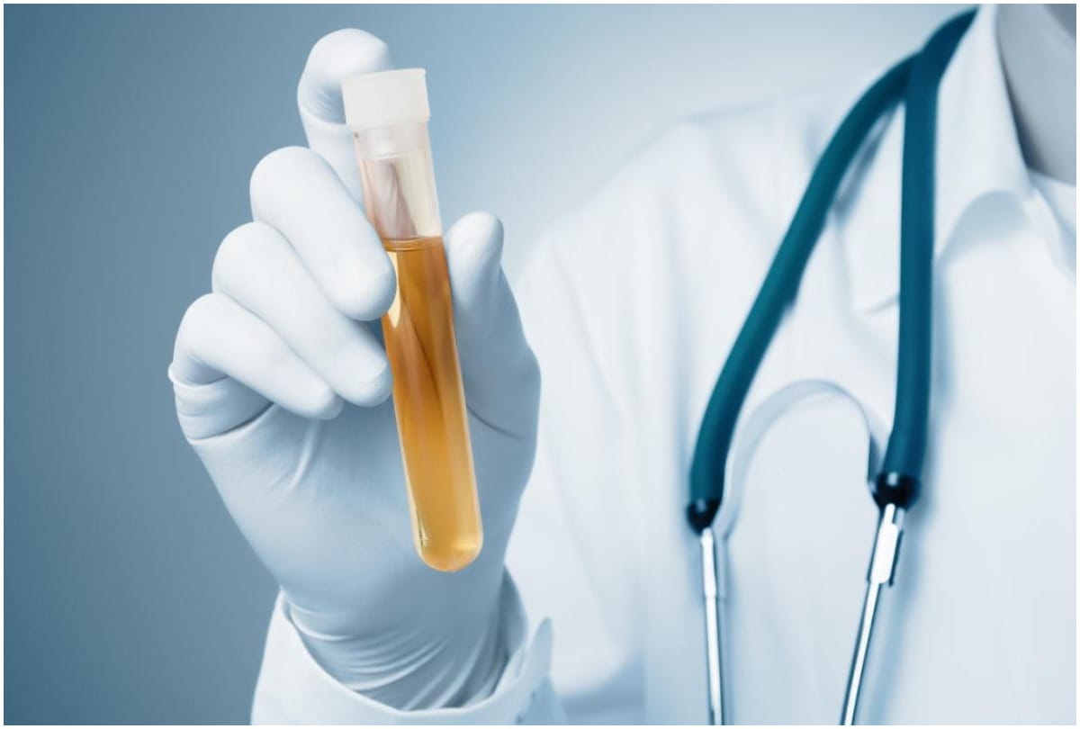 For dope test, a person gave sample of water instead of urine
