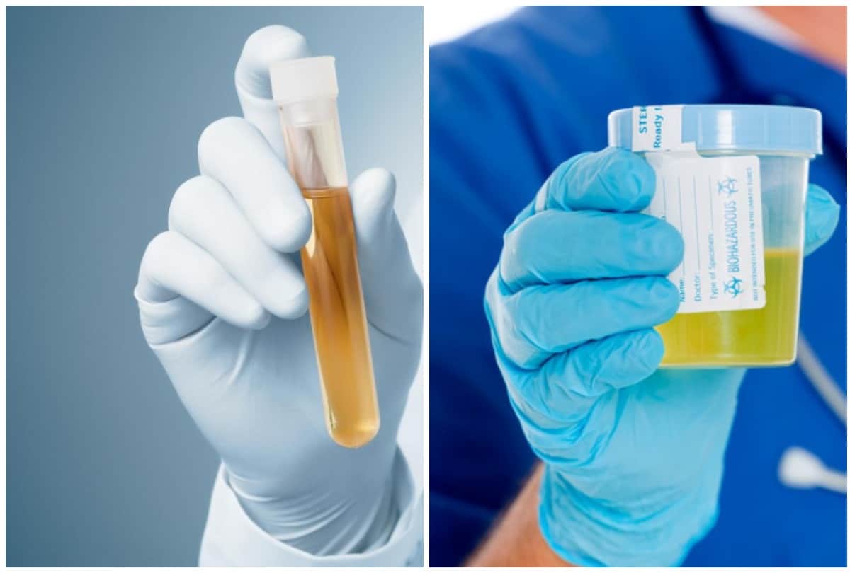 urine colour can indicate your health problem