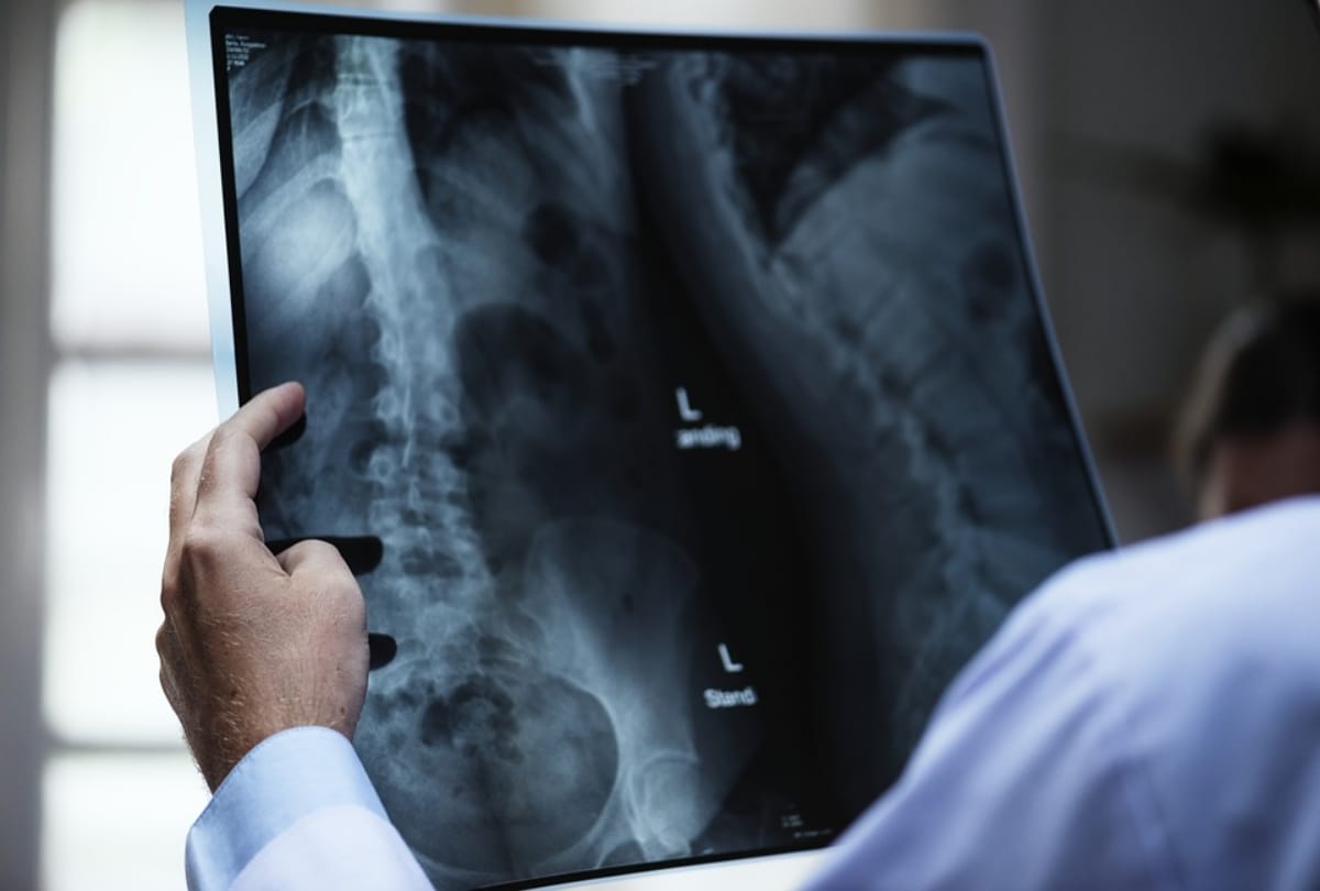 excess of vitamin b6 and b12 cause severe bone problems hip fracture in women