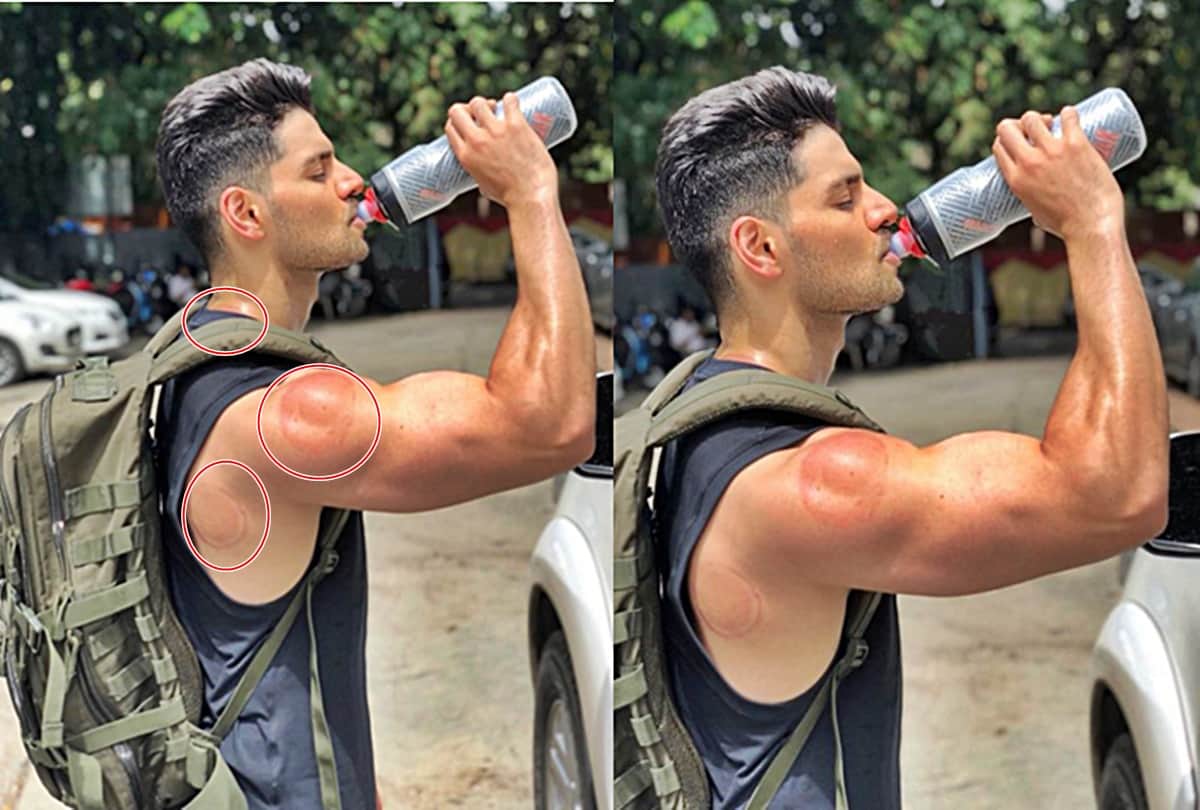 Fans are worried for red Marks on Sooraj pancholi Body, users replied answers