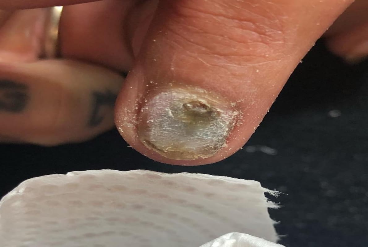 these 5 mark on nails can be sign of skin cancer