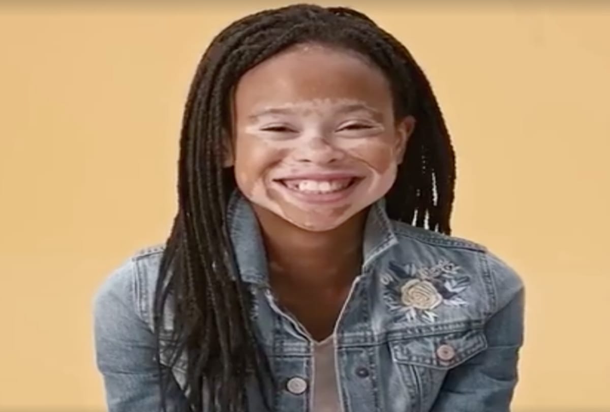 world vitiligo day 2019 time to break stereotypes about white spot disease