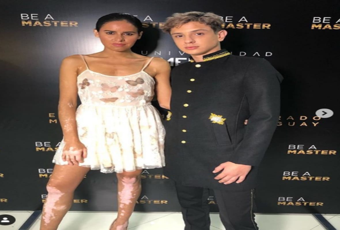 world vitiligo day 2019 time to break stereotypes about white spot disease