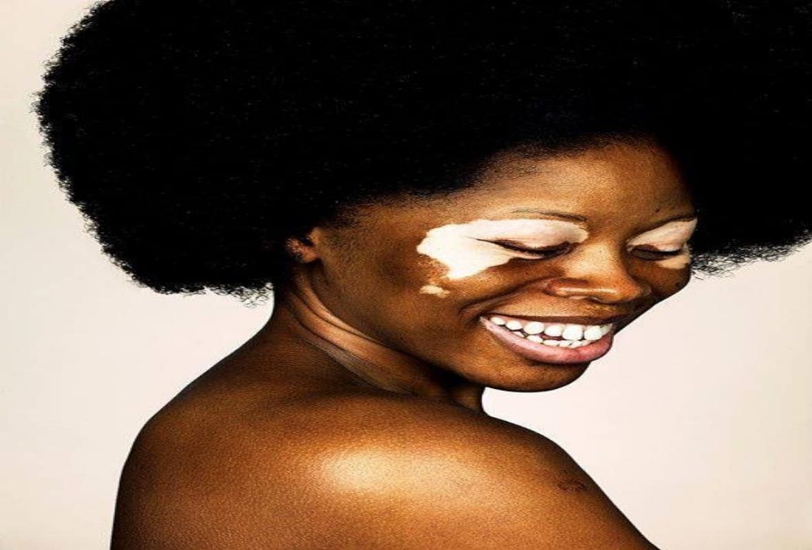 world vitiligo day 2019 time to break stereotypes about white spot disease