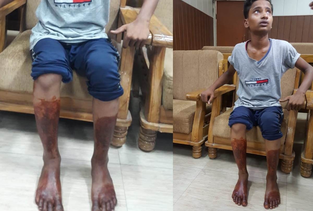 third degree torture by police to a teenager who refused to commit a theft in lucknow