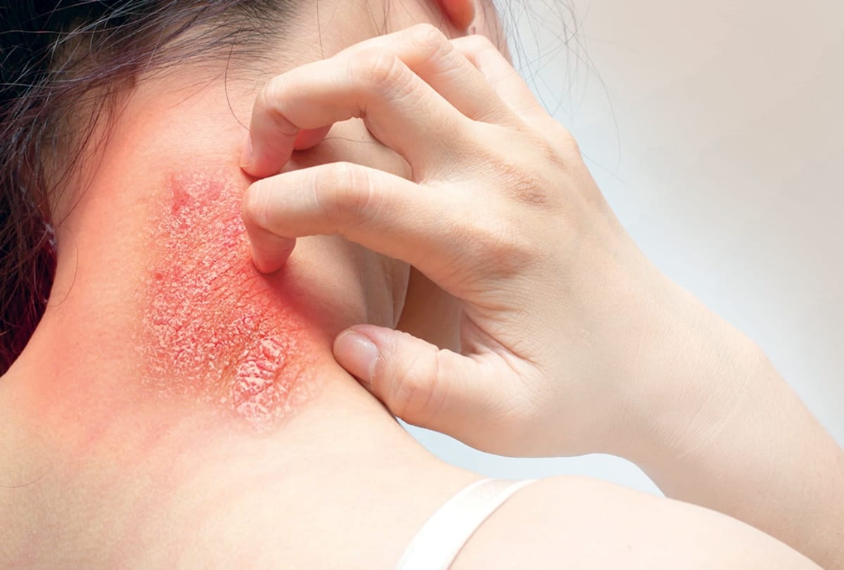 home remedies for ringworm eczema itching treatment with this flower in seven days