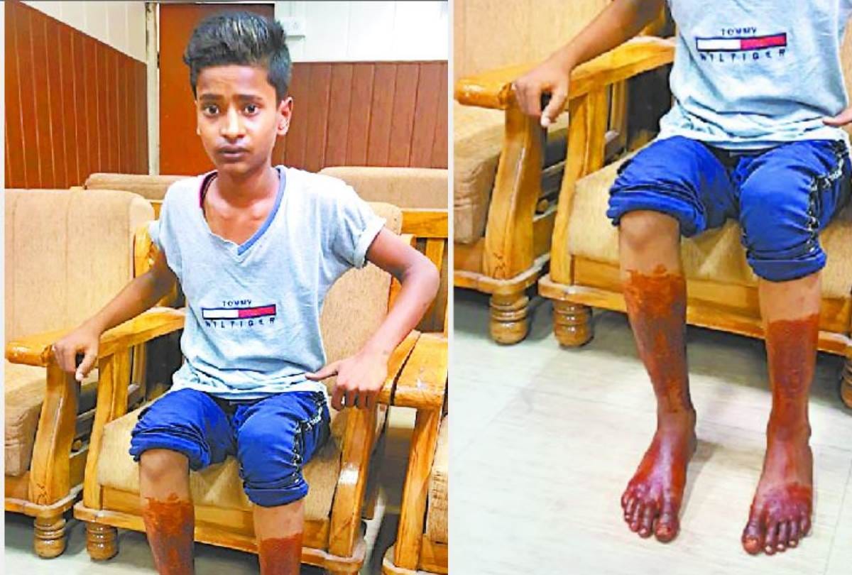 third degree torture by police to a teenager who refused to commit a theft in lucknow