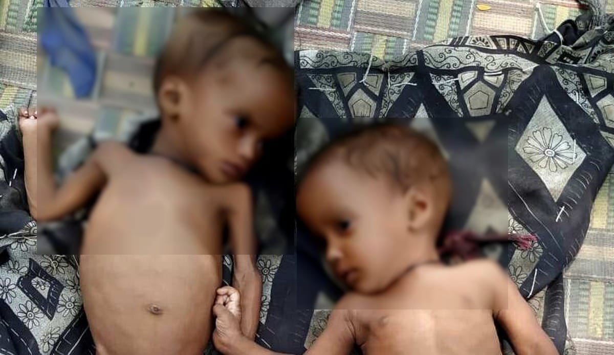 Malnourished Twins Sister under medication In Varanasi