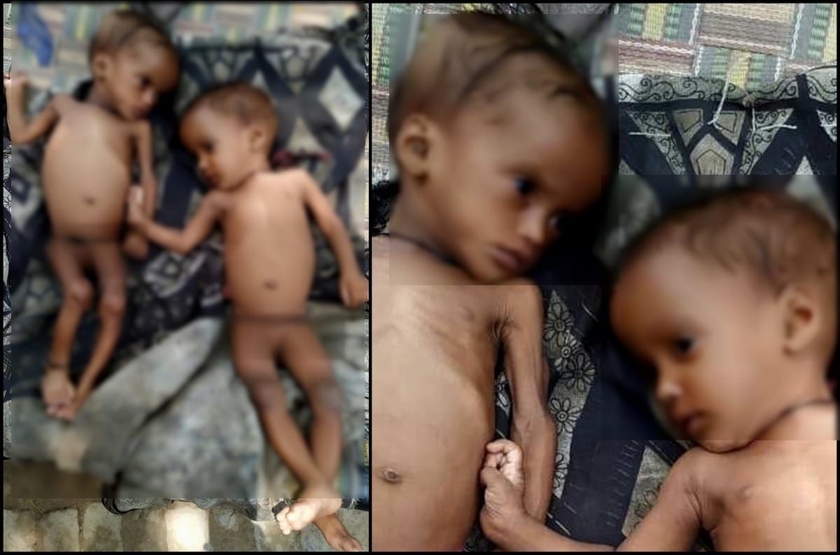 Malnourished twins sister find in varanasi aanganbadi worker will investigated