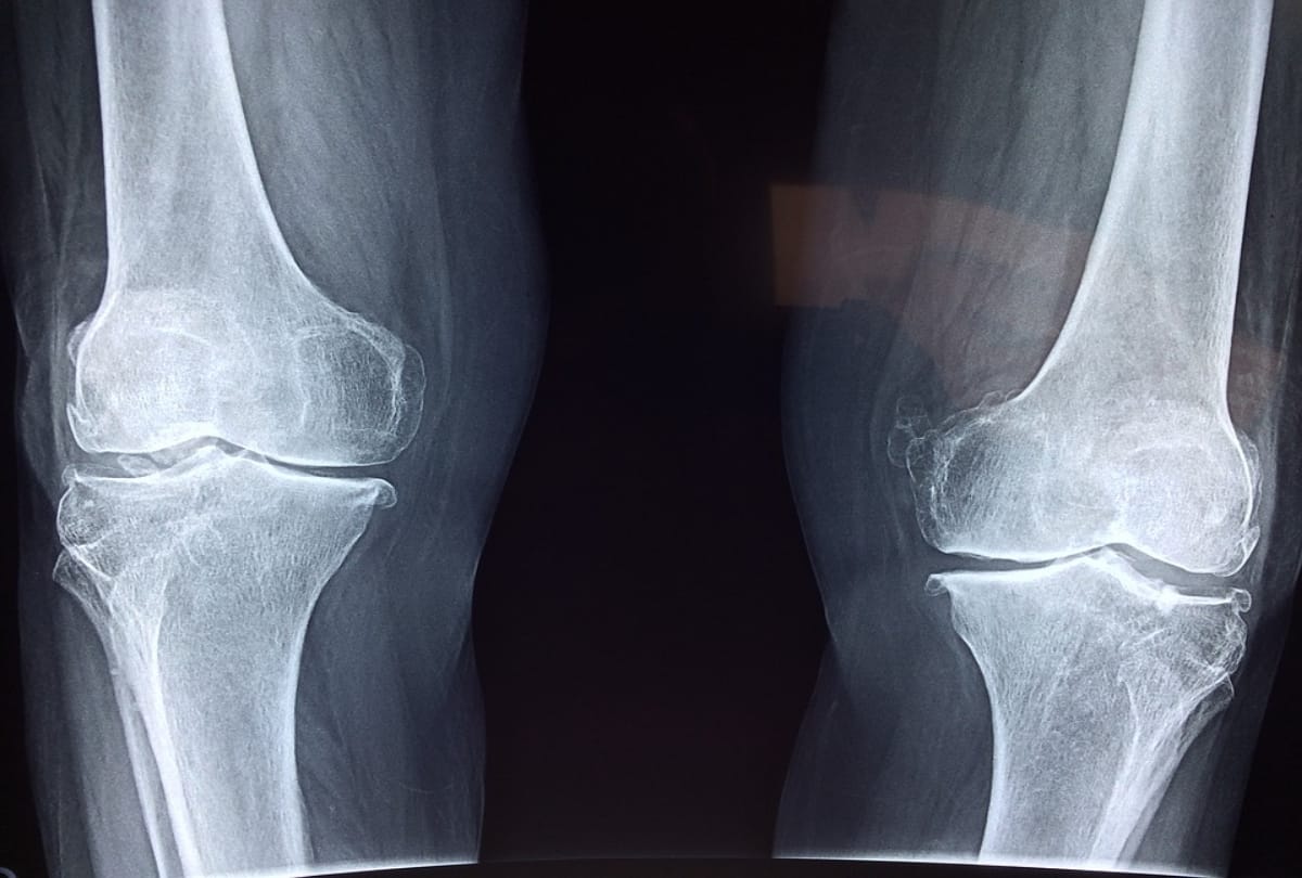 things you should know before knee replacement surgery