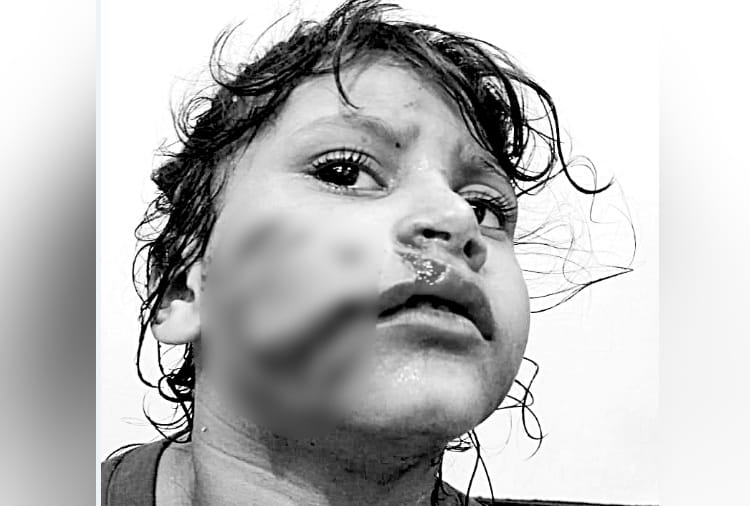 dog bite in panchkula, stray dog bites four year old girl child