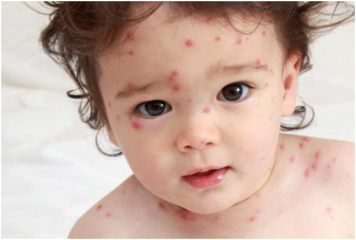 home remedies for chickenpox