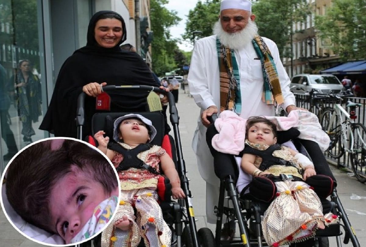 two year old conjoined twins from pakistan separated in a rare surgery in London