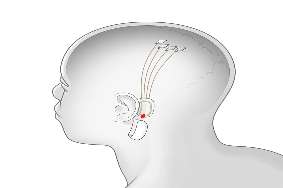 Neuralink will change your world