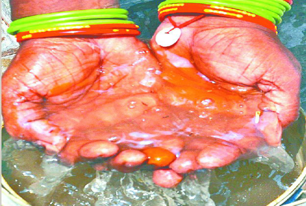 contaminated water supply in Agra