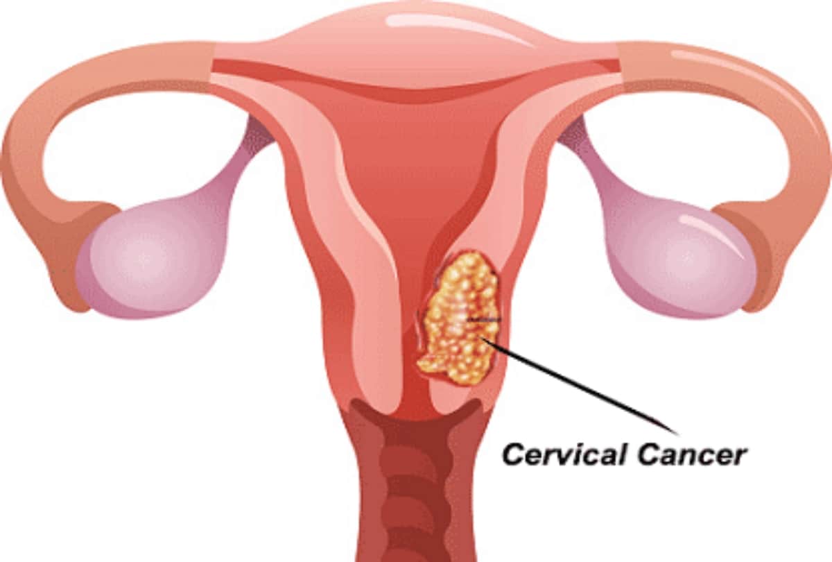everything to know about cervical cancer causes, symptoms and cure