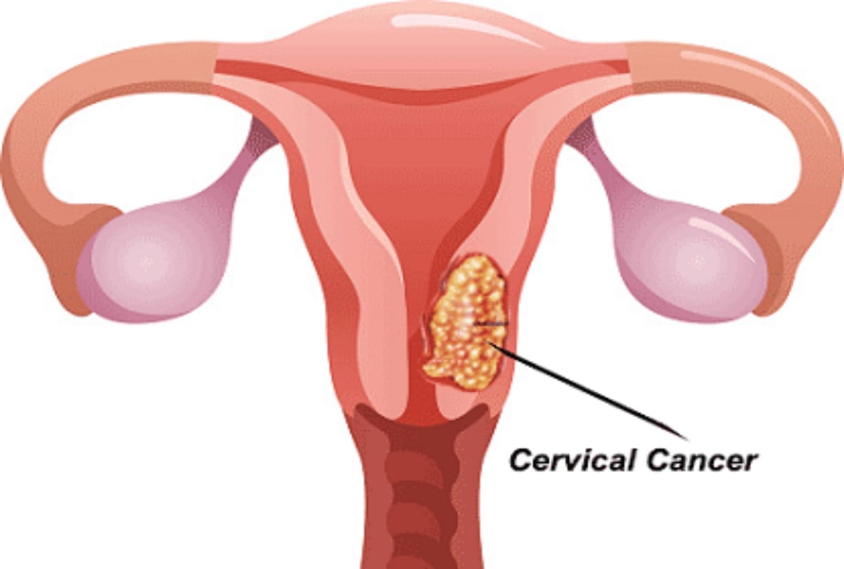 Cervical cancer: Symptoms, causes, stages, and treatment