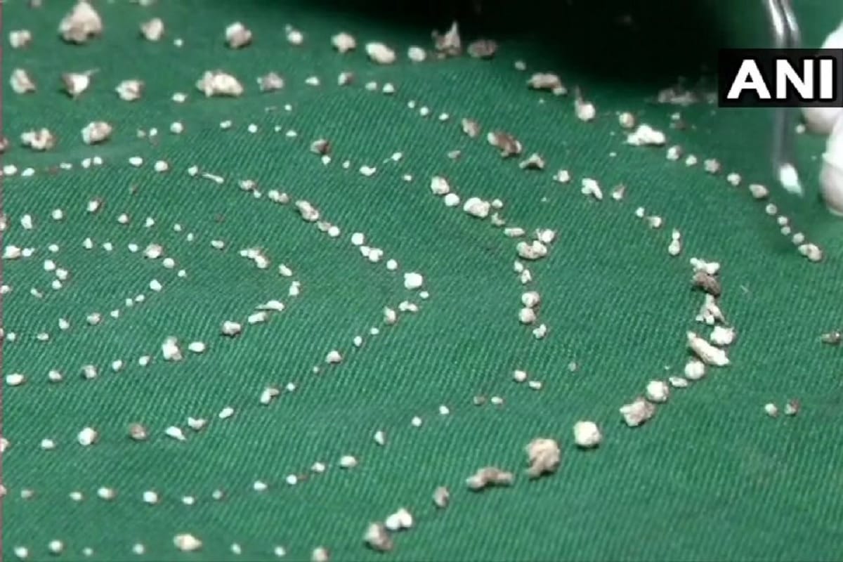 526 teeth were removed from the lower jaw of a 7 year old boy in Chennai