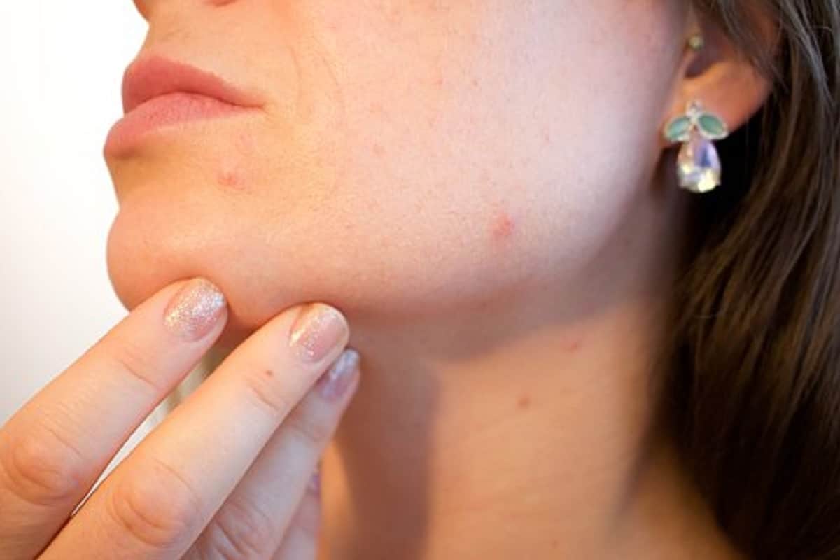 home remedies to remove pimple scars on face