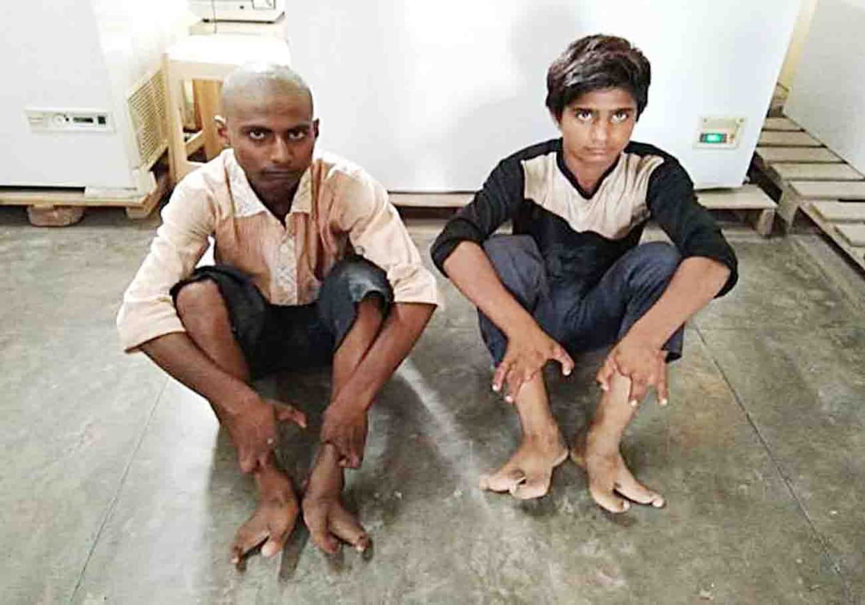 hand like fingers in the feet, family of kanpur dehat suffering from rare disease