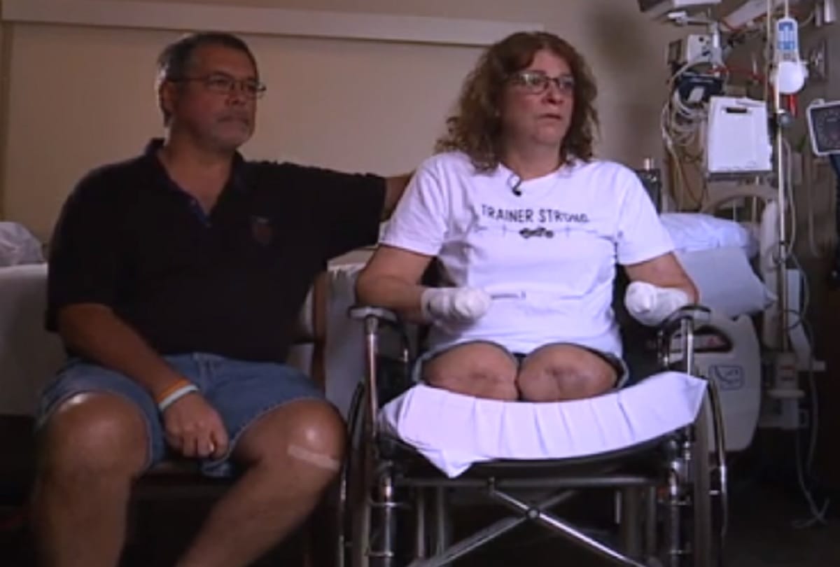 woman lost her hands and legs to an infection from dog kisses in Ohio USA