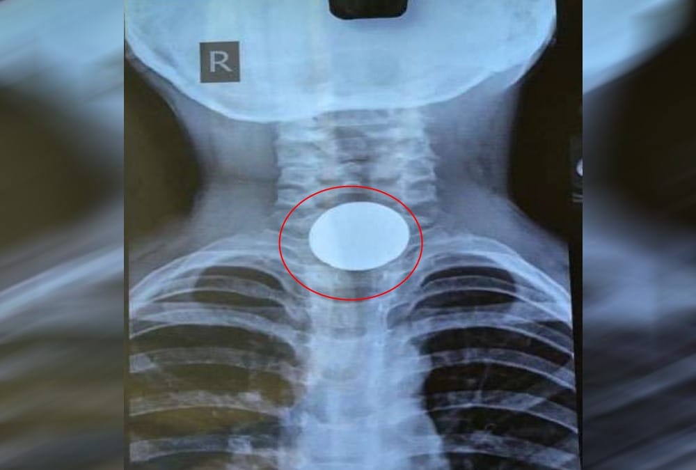 Five year old Child swallowed 10 rupees coin Aiims Doctors taken out