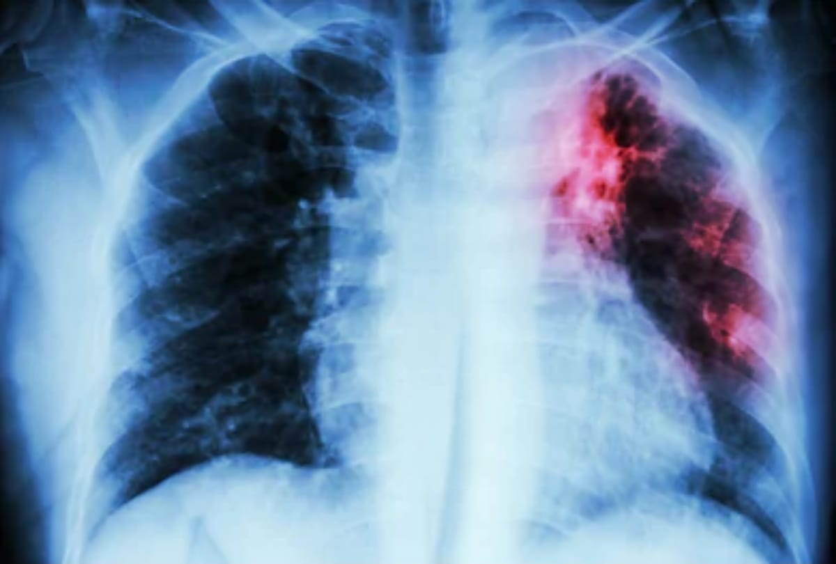 tuberculosis harmful disease can affects these people especially