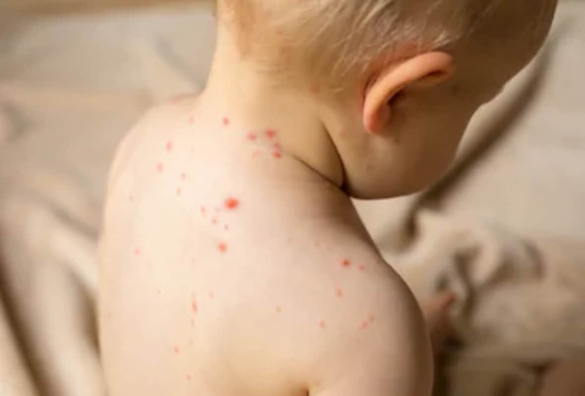 risk of diseases like viral fever encephalitis pneumonia diarrhea and vomiting to children increased in changing season