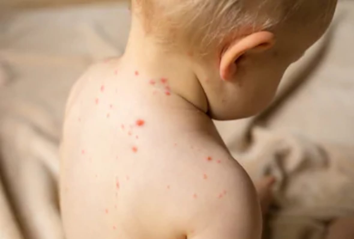 risk of diseases like viral fever encephalitis pneumonia diarrhea and vomiting to children increased in changing season