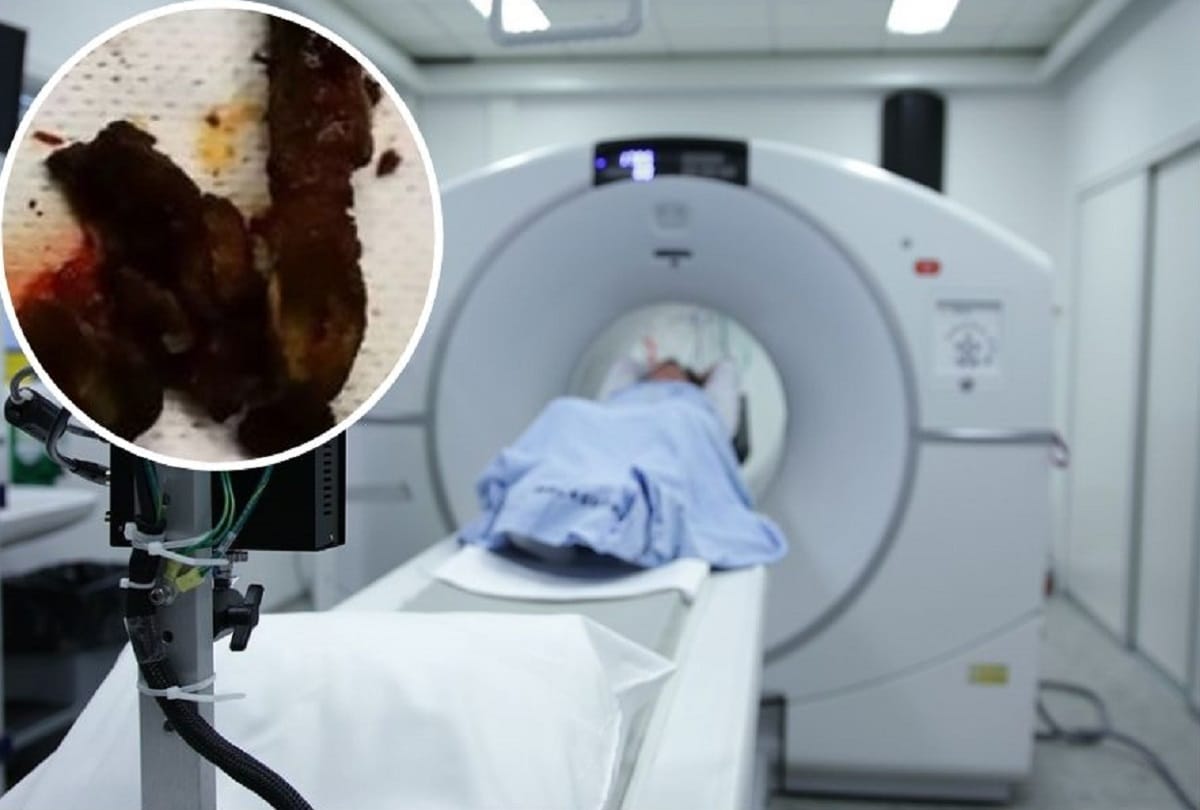 Doctors remove Toothbrush from man stomach that he swallowed 20 years ago in China