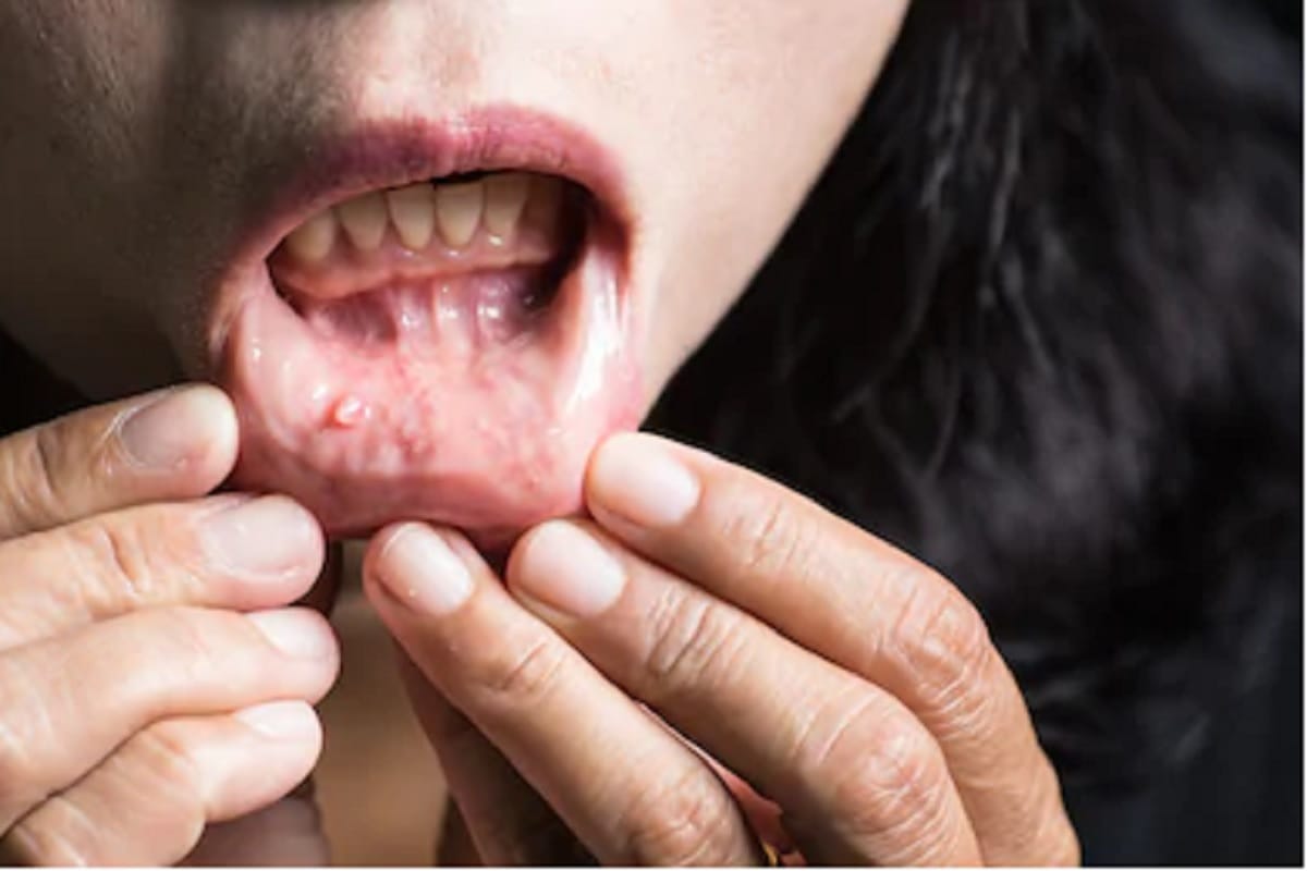 poor oral health can born liver cancer