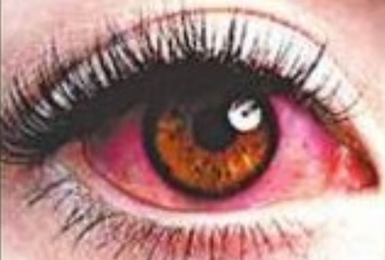 Disease That Cause Eye Flu Like Symptoms Know What Causes Redness And Itching In Eyes Amar