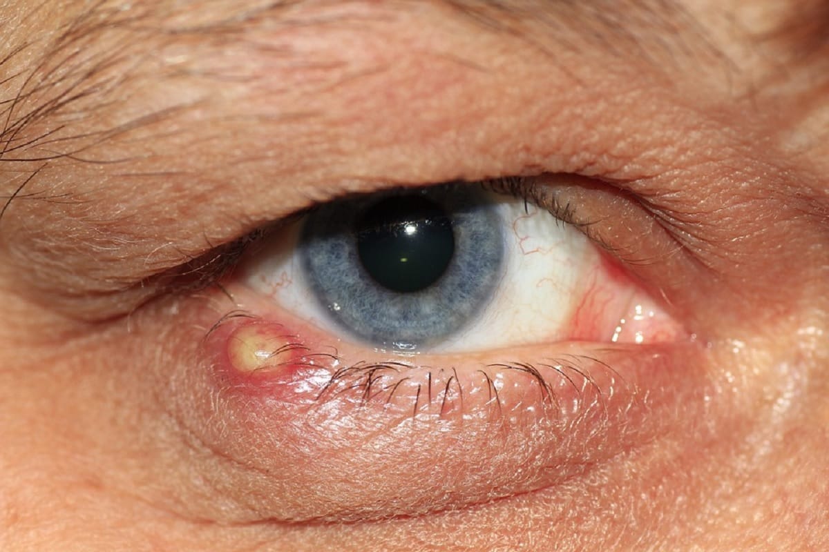you need to know everything about trachoma and tips to prevent from its infection