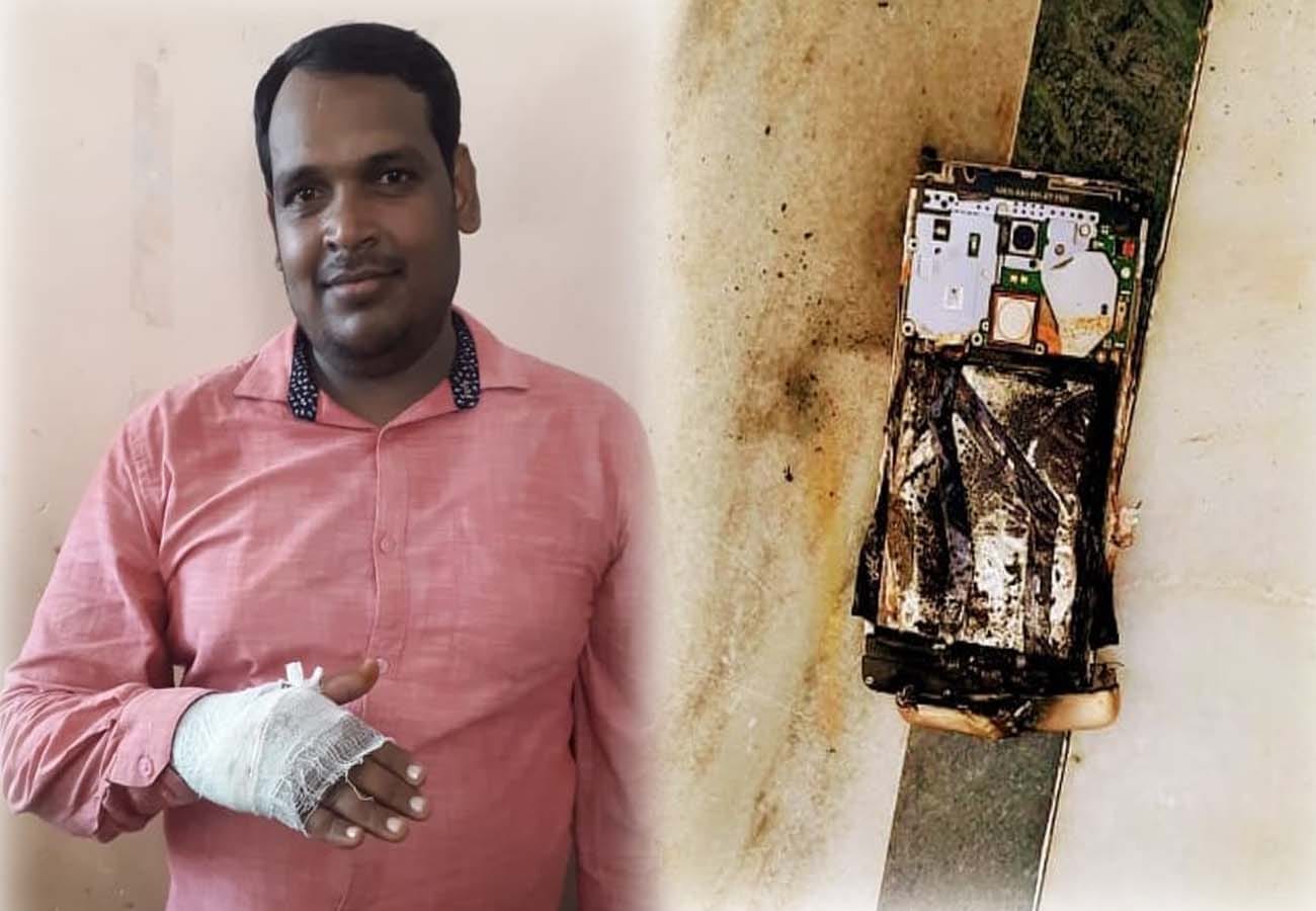 मोबाइल फोन ब्लास्ट होने से सीएचसी का लैब टेक्नीशियन झुलसा