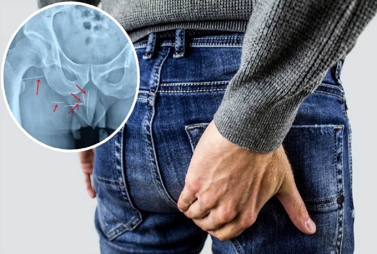 Doctors remove 8 metal needles from chinese mans butt who stuck for 10 years