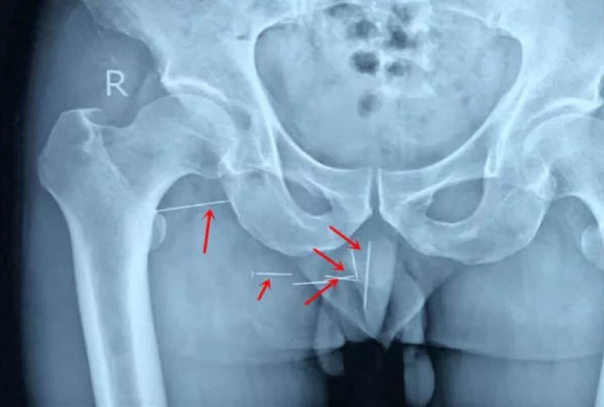 Doctors remove 8 metal needles from chinese mans butt who stuck for 10 years