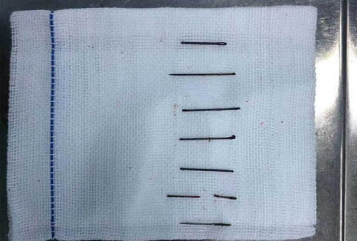 Doctors remove 8 metal needles from chinese mans butt who stuck for 10 years